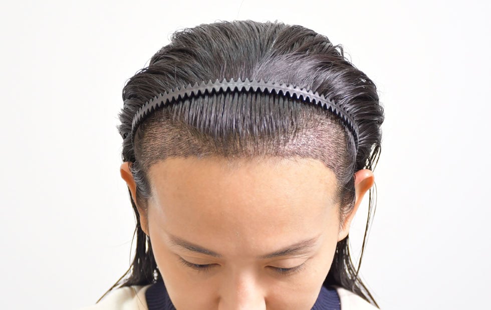 เจาะลึกทุก วิธีสระผมหลังปลูกผม เพื่อรักษากราฟท์ให้อยู่กับเรานานที่สุด