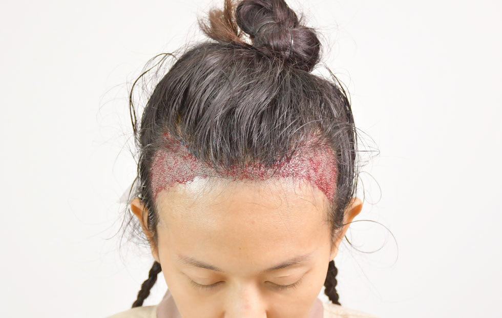 เจาะลึกทุก วิธีสระผมหลังปลูกผม เพื่อรักษากราฟท์ให้อยู่กับเรานานที่สุด