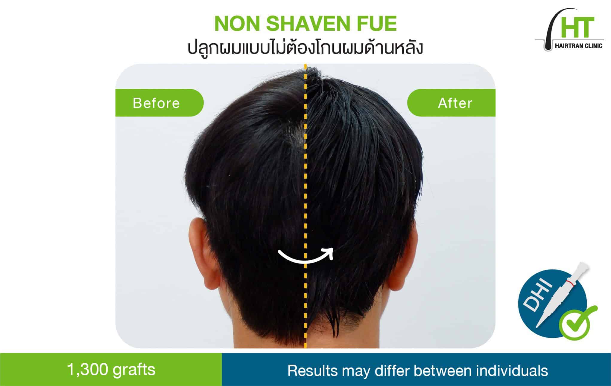 ปลูกผมแบบไม่ต้องโกนผม เทคนิค NON SHAVEN FUE