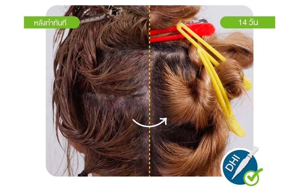 ปลูกผมถาวร