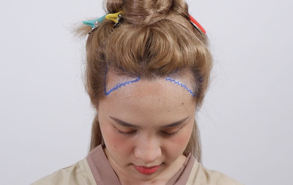 ปลูกผมถาวร