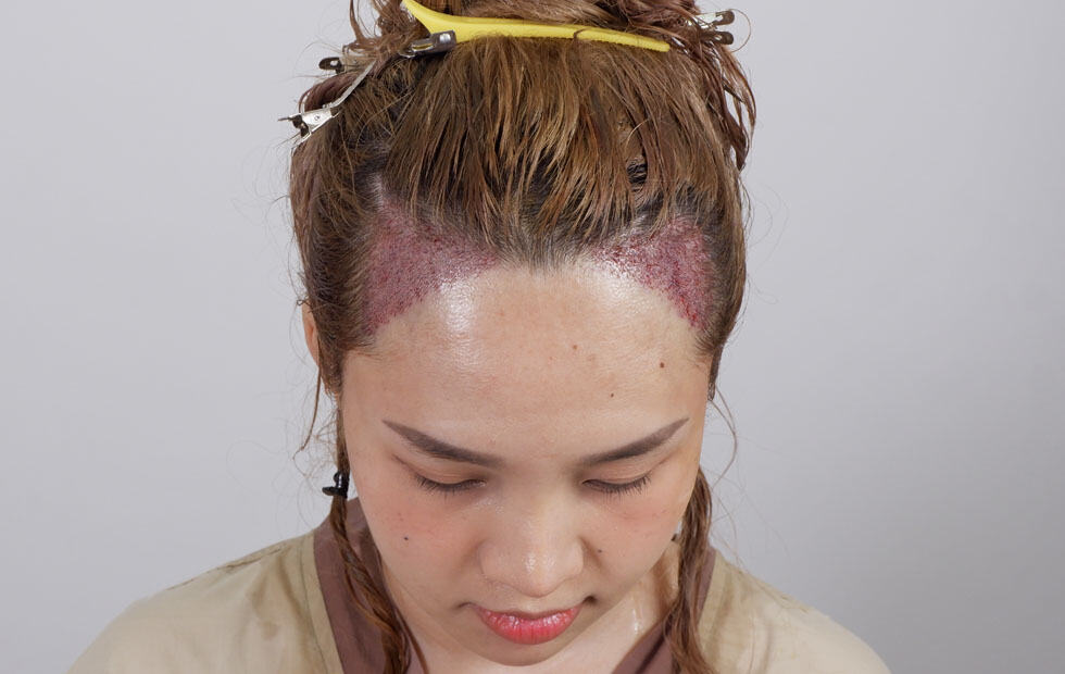 ปลูกผมถาวร